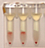 A positive antibody screen